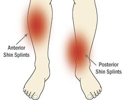 shin splints ή Medial Tibial Stress Syndrome