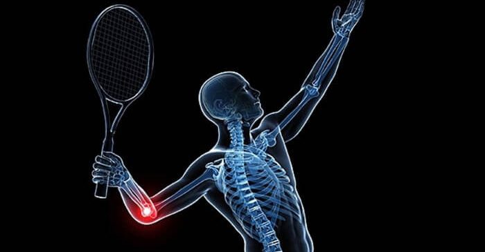 έξω επικονδυλίτιδα, αγκώνας του τέννις, (Tennis Elbow)
